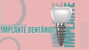 Implantes Dentários: Por Que São a Escolha Superior para a Substituição de Dentes?