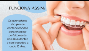 DENTISTA ALINHADORES TRANSPARENTES EM SANTO ANDRÉ – PERFEITO PARA REUNIÕES, FESTAS E FOTOS