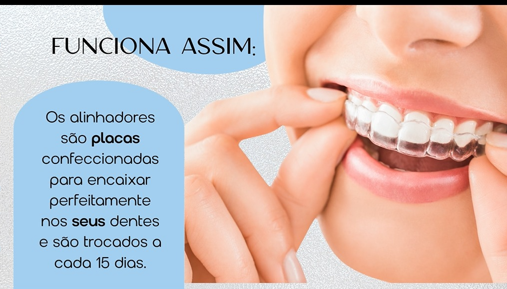 z-light-alinhadores-e-aparelhos-transparentes-em-santo-andre-abc-paulista-sp-dentcor.