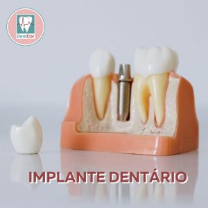 Se você está procurando uma alternativa duradoura e natural para substituir seus dentes perdidos, o implante dentário é a melhor opção.